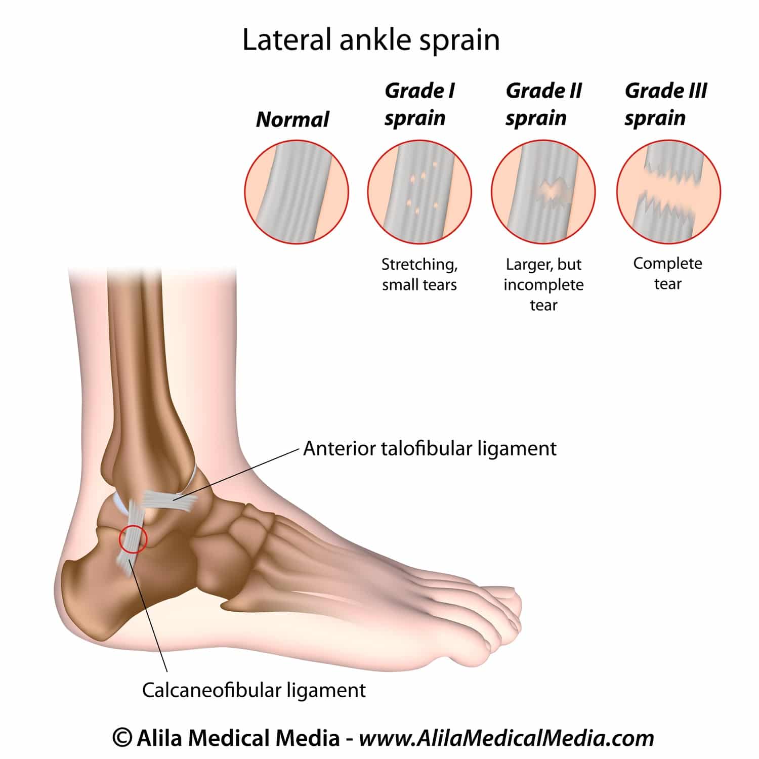 Ankle sprain grading